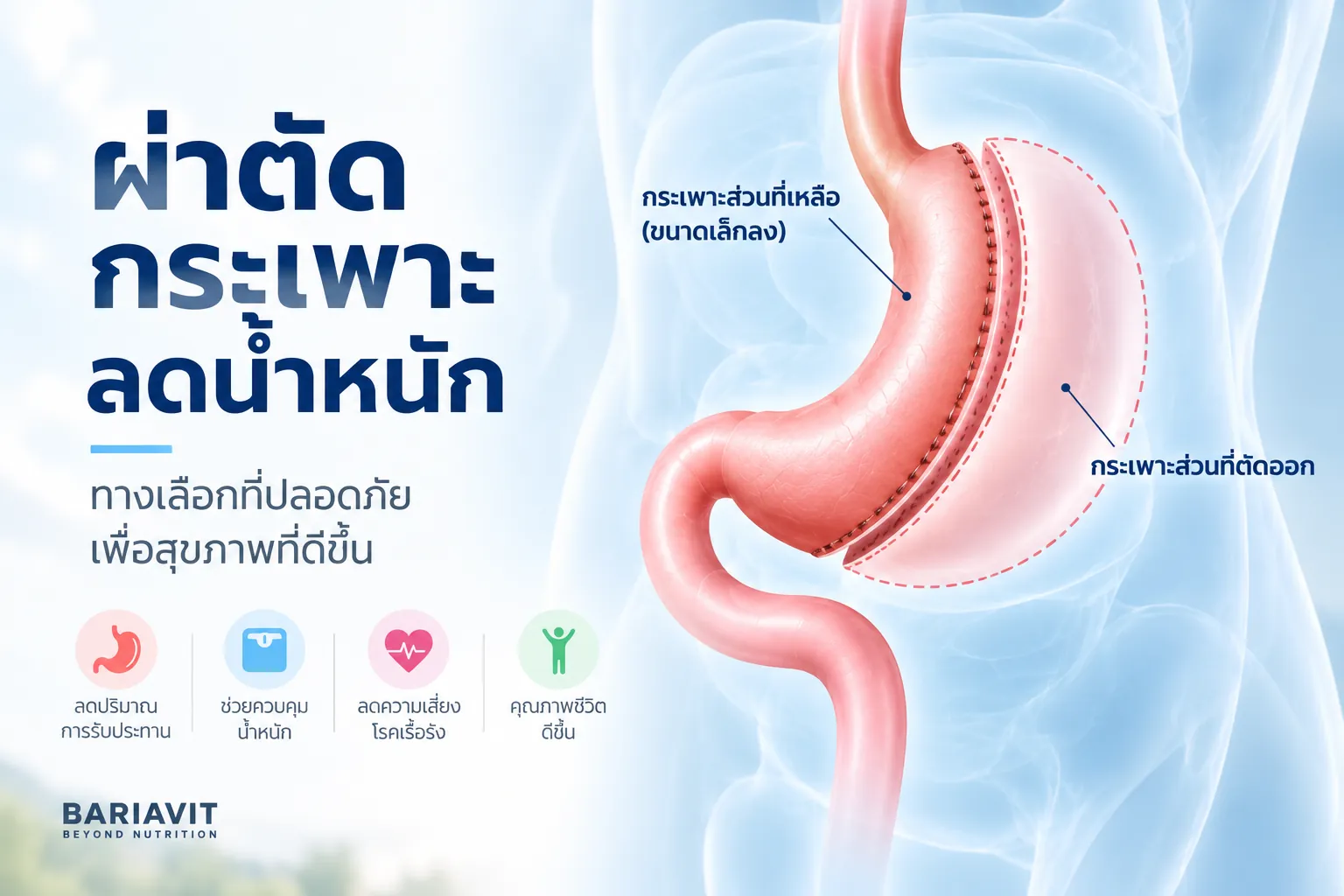 bariavit-bariatric-banner-sleeve-gastrectomy